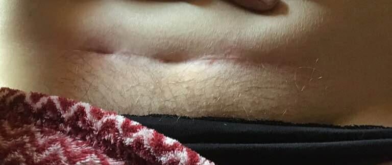 Cesarean scar MSTR 2 Susan Hagen