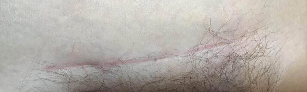 Cesarean scar MSTR 1 Susan Hagen